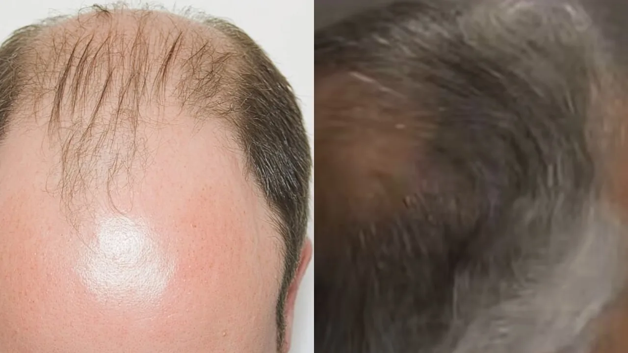 ஆண்களின் தலைமுடி  வழுக்கை பிரச்னைக்கு நிரந்தர தீர்வு – புதிய மருந்தை கண்டுபிடித்த அயர்லாந்து நிறுவனம்!