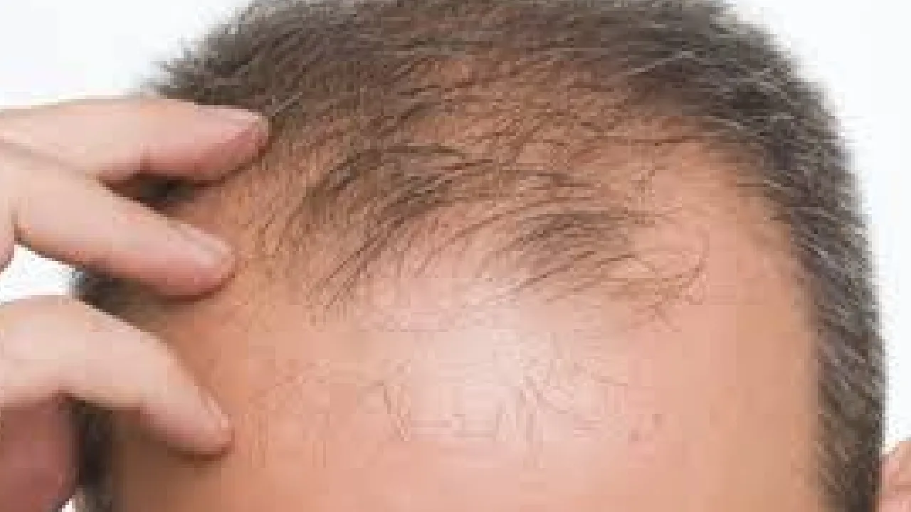 வெற்றிப்பாதையில் தலைமுடி உதிர்வு தடுப்பு மருந்து : வழுக்கை பிரச்னைக்கு விரைவில் தீர்வு வருகிறது புதிய மருந்து!